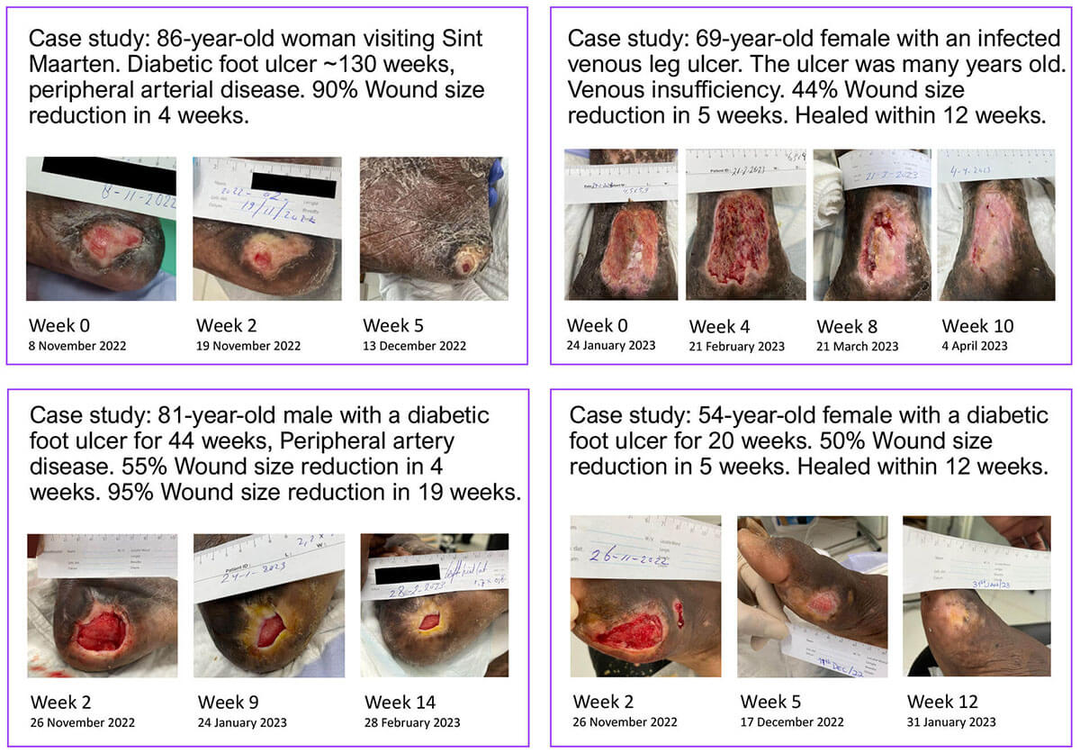 Wound closure - photos of wounds before and during PLASOMA treatment