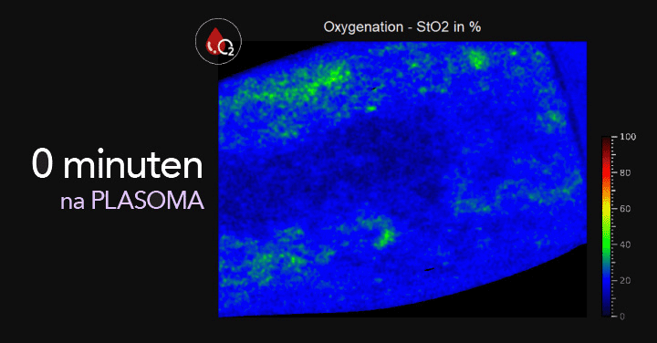 Hittefoto van zuurstofverzadiging in het bloed 0 minuten na PLASOMA