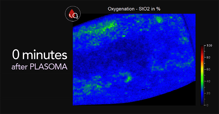 Heat image of oxigen saturation in the blood 0 minutes after PLASOMA