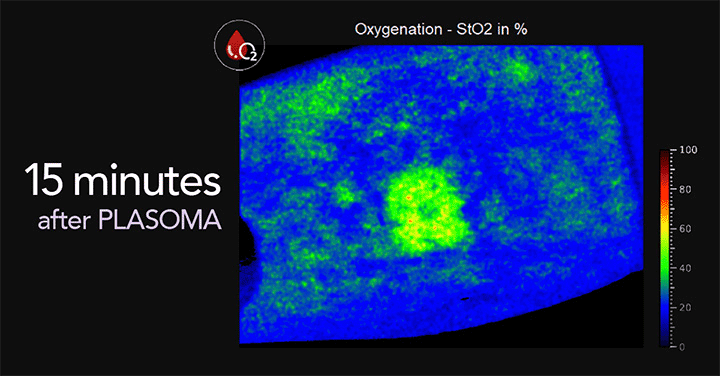 Heat image of oxigen saturation in the blood 15 minutes after PLASOMA