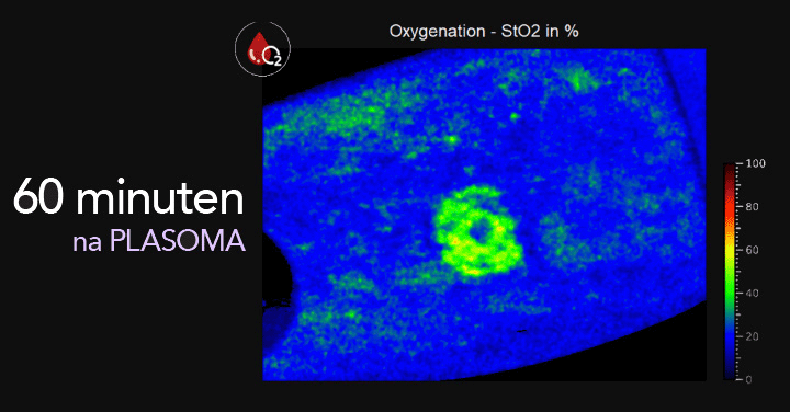 Hittefoto van zuurstofverzadiging in het bloed 60 minuten na PLASOMA