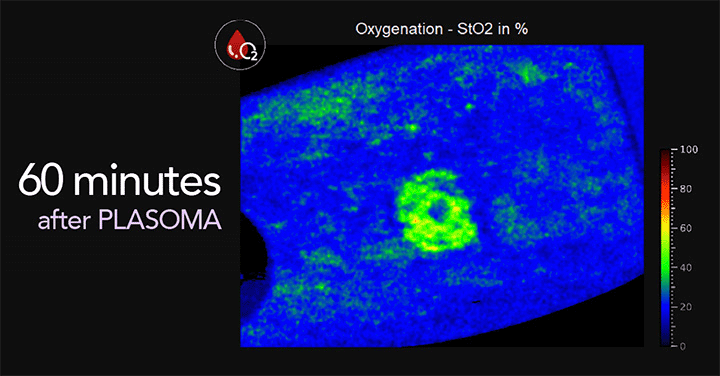 Heat image of oxigen saturation in the blood 60 minutes after PLASOMA