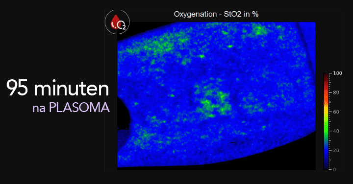 Hittefoto van zuurstofverzadiging in het bloed 95 minuten na PLASOMA