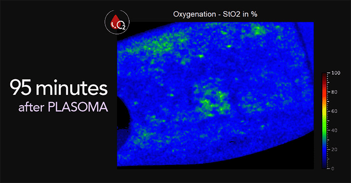 Heat image of oxigen saturation in the blood 95 minutes after PLASOMA