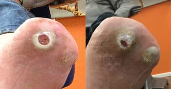 Case2_wound_images730x381