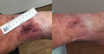 Case8_wound_images730x381