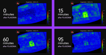 Oxigen saturation in blood increases after PLASOMA up to 95 minutes after treatment. Heat camera visualises this.