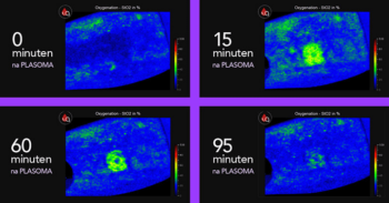 Zuurstofsaturatie in het bloed neemt toe na PLASOMA tot wel 95 minuten na behandeling. Zichtbaar met hittecamera.