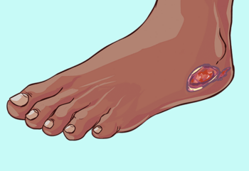 Illustration of foot with heel wound